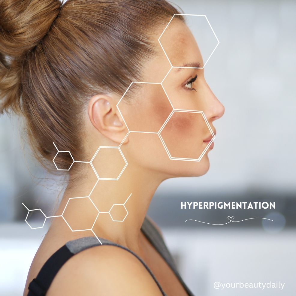 picture of a side image of a woman with skin hyperpigmentation highlighted with hexagonal shapes