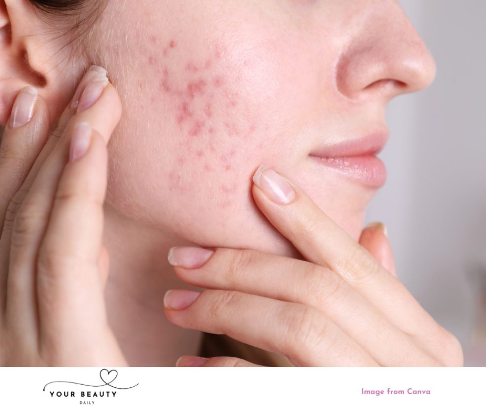 picture of someone with rosacea on their face