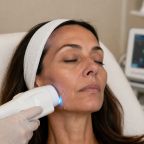 picture of Woman receiving energy-based skin tightening treatment on jawline after weight loss